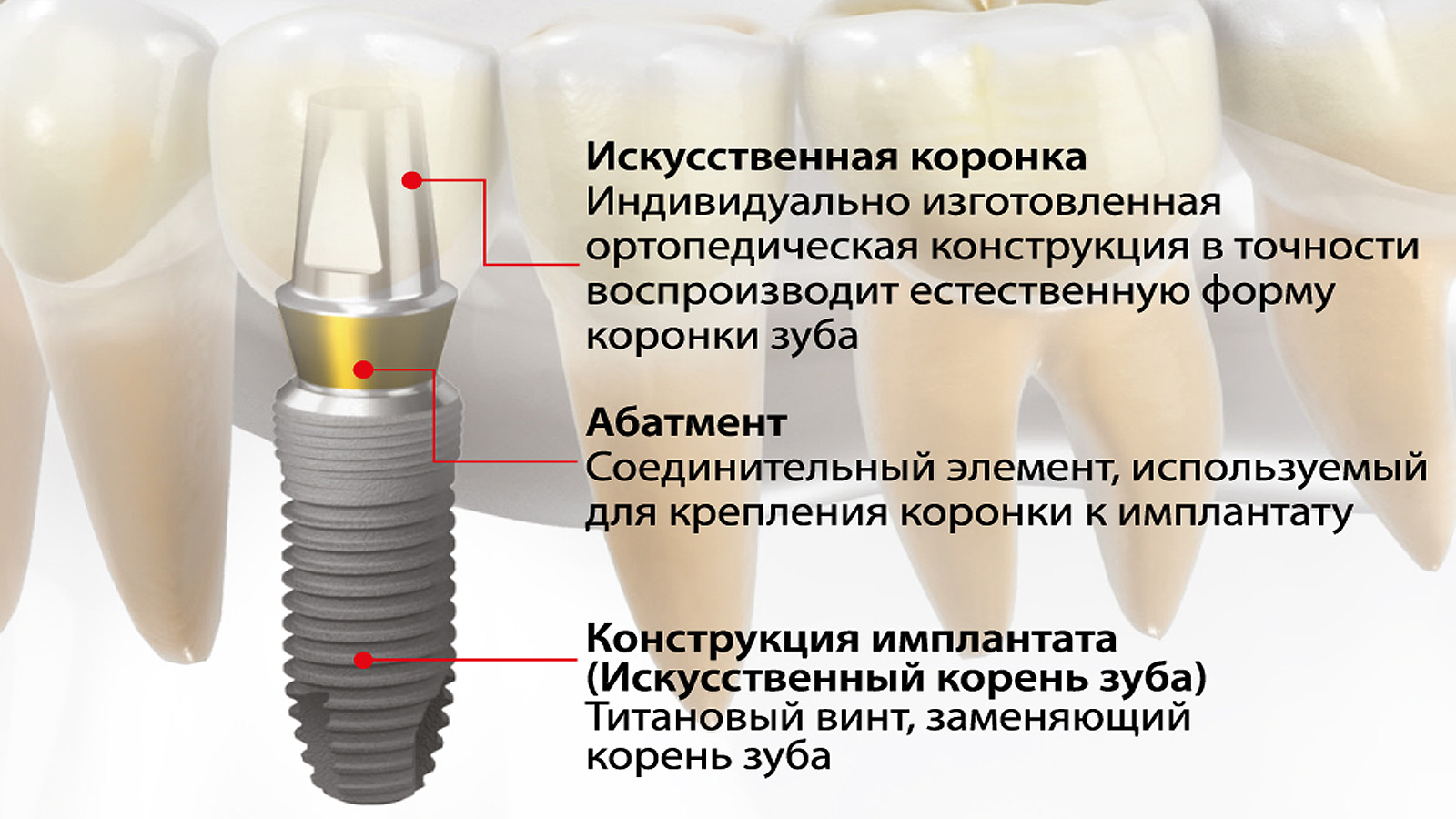 строение зубного импланта