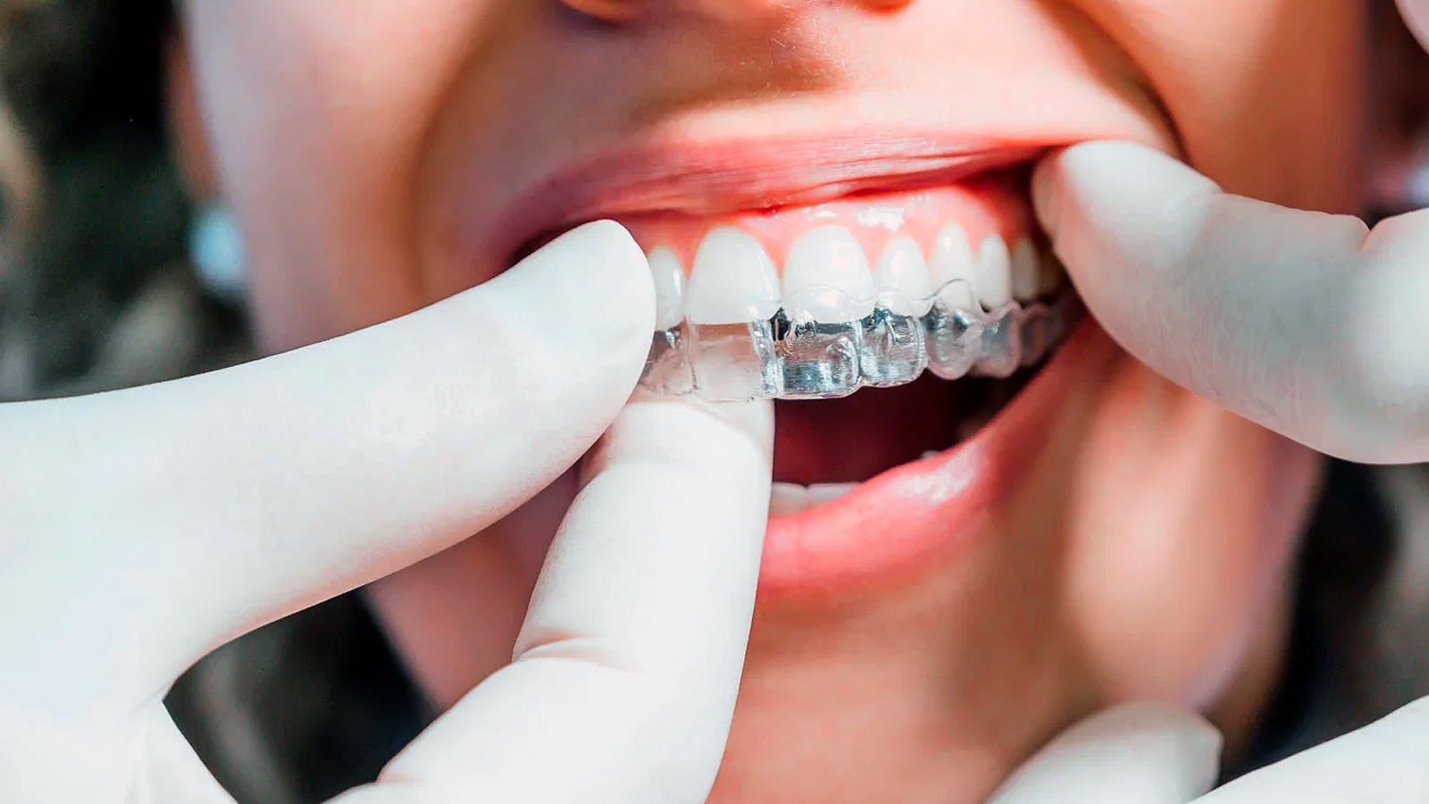 installation of Invisalign aligners