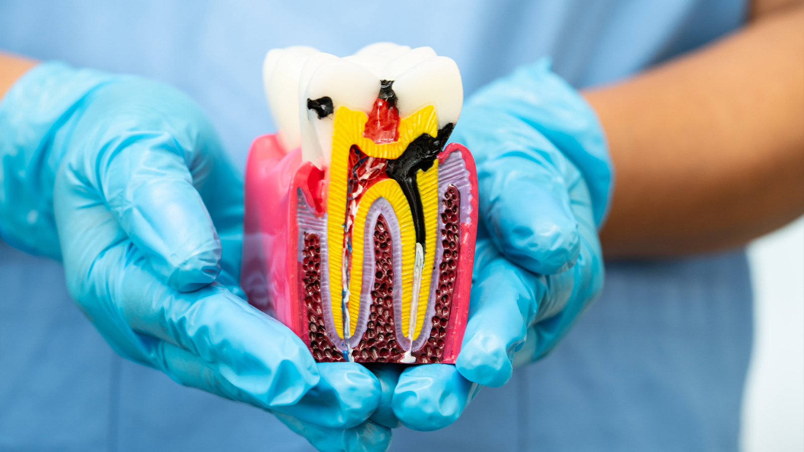 Hands wearing medical gloves hold a model of a tooth affected by caries.