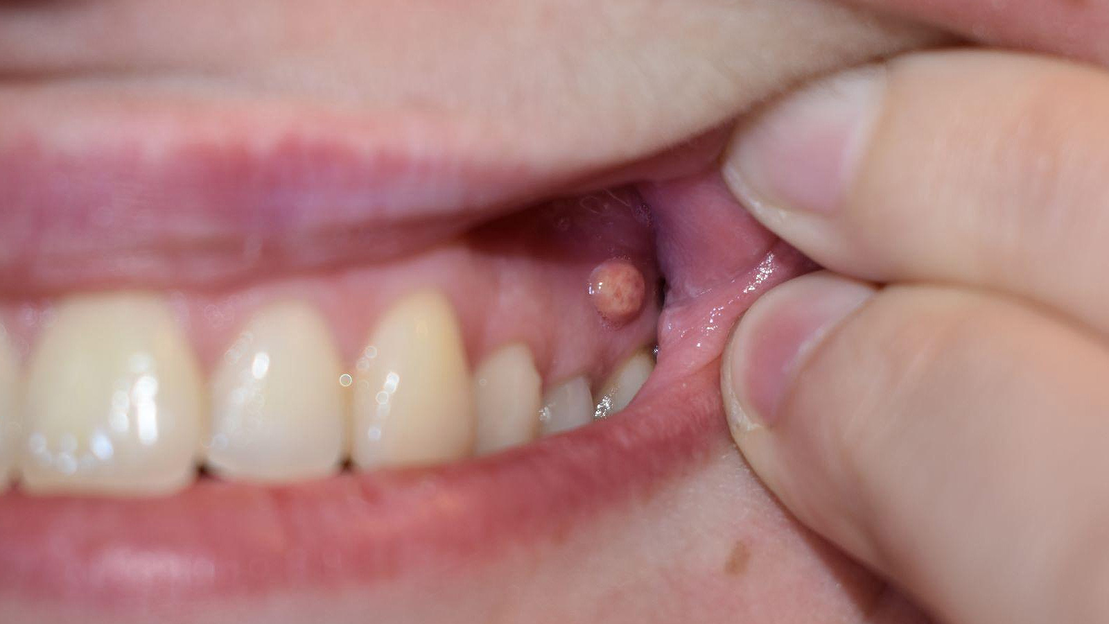 киста у основания корня зуба