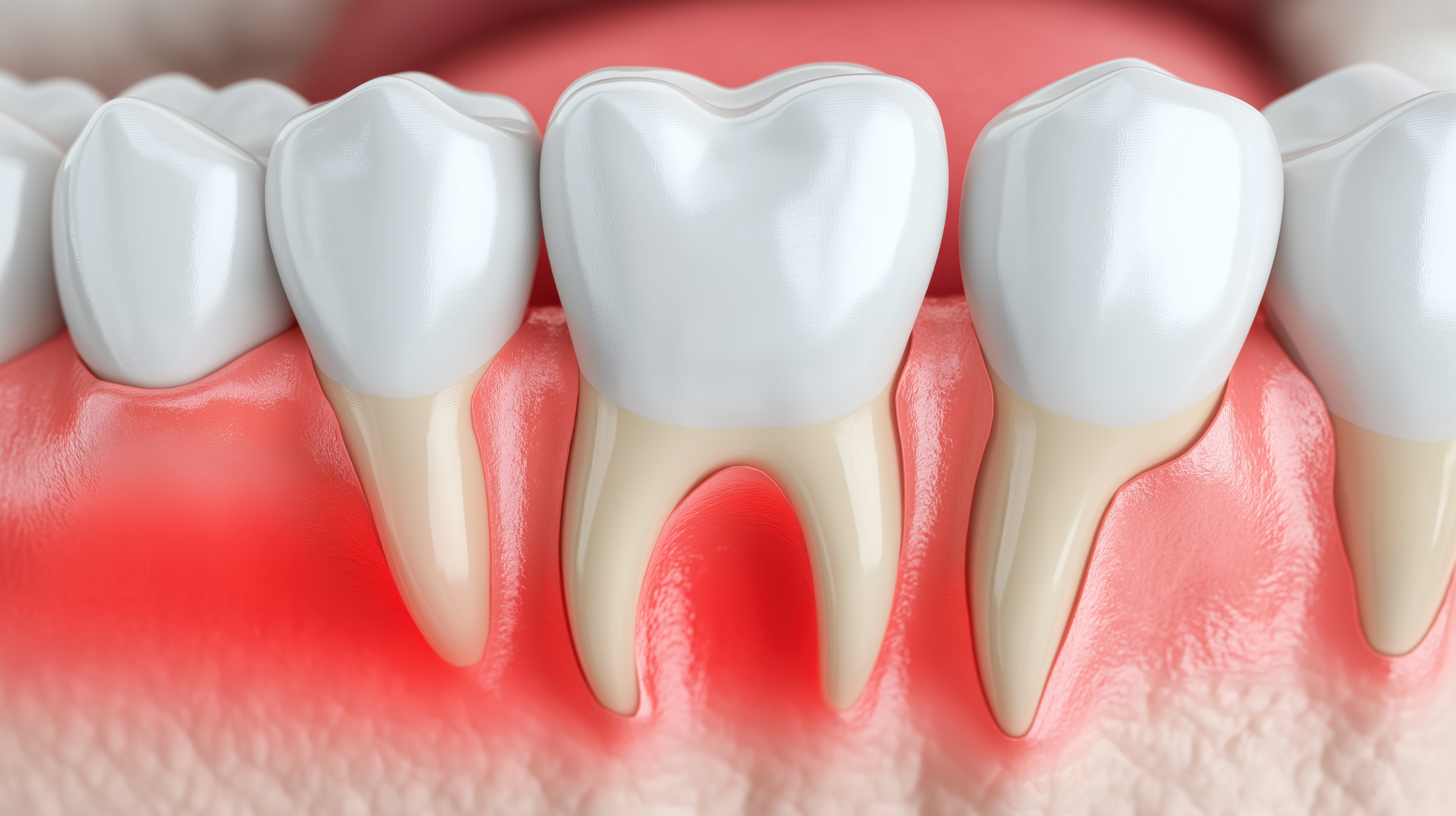 Gum disease and inflammation from Periodontitis.