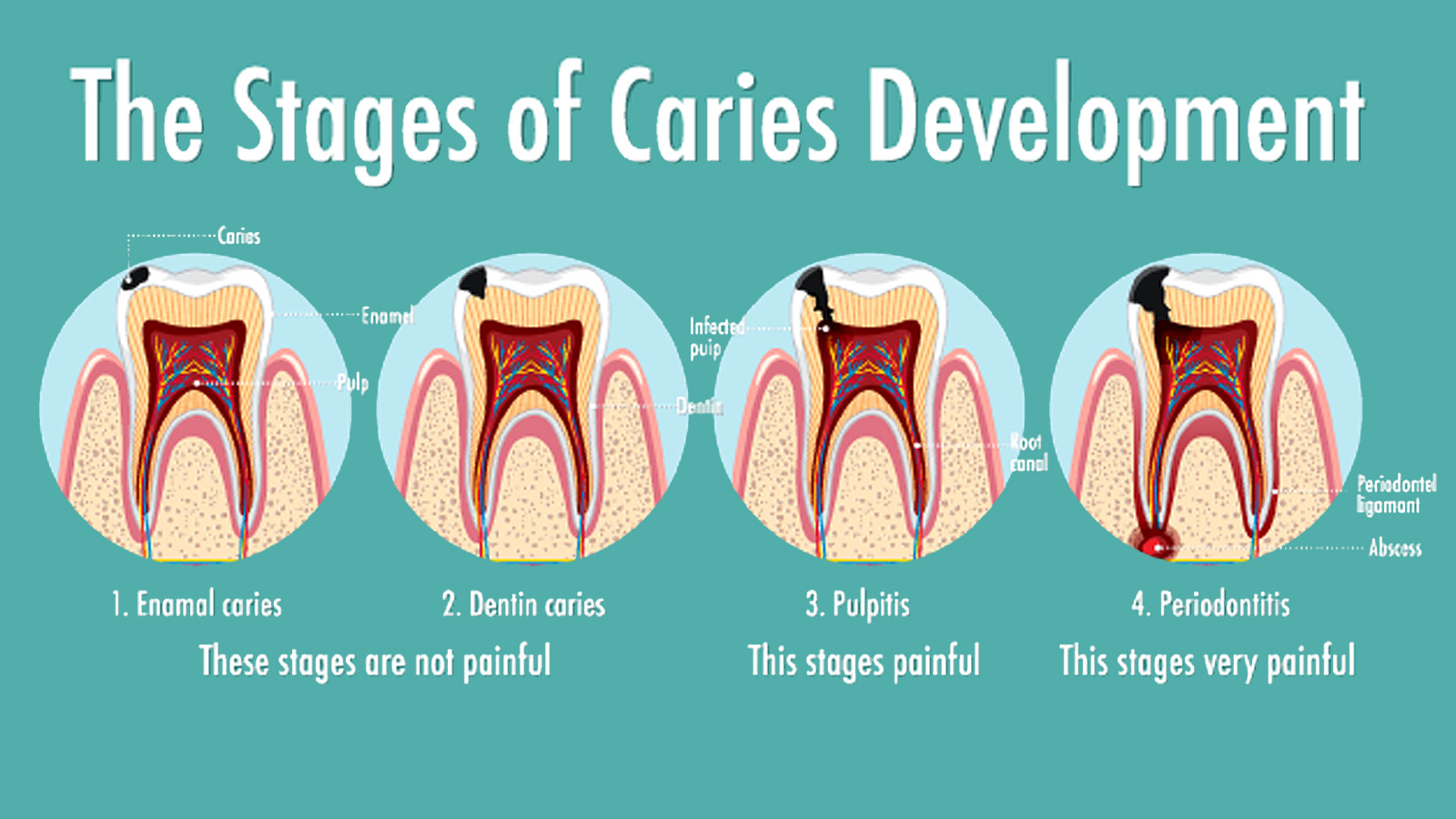 Infografic al omului în etapele dezvoltării cariilor dentare