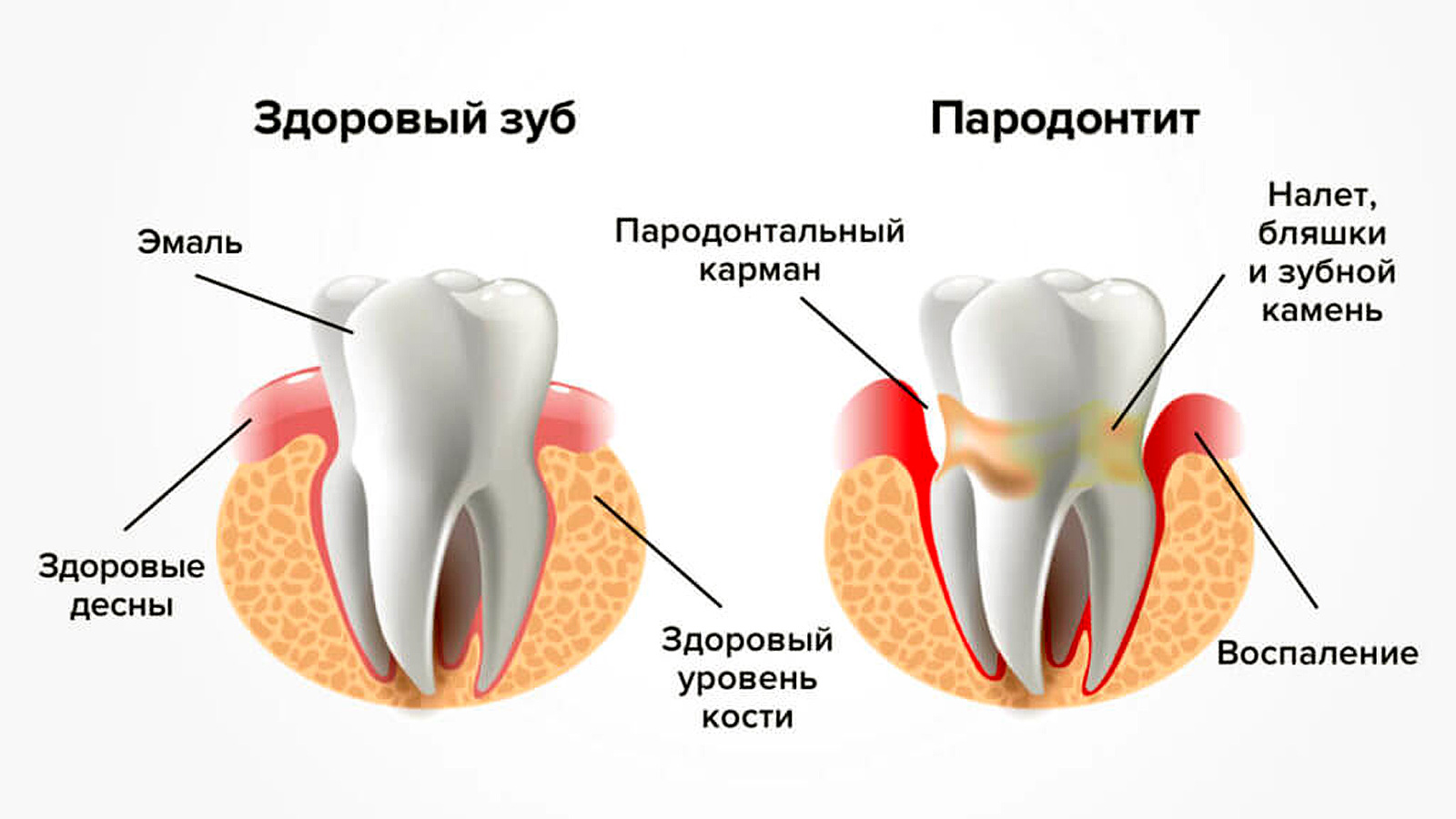 Зуб в здоровой дусне и зуб в десне, пораженной пародонтитом