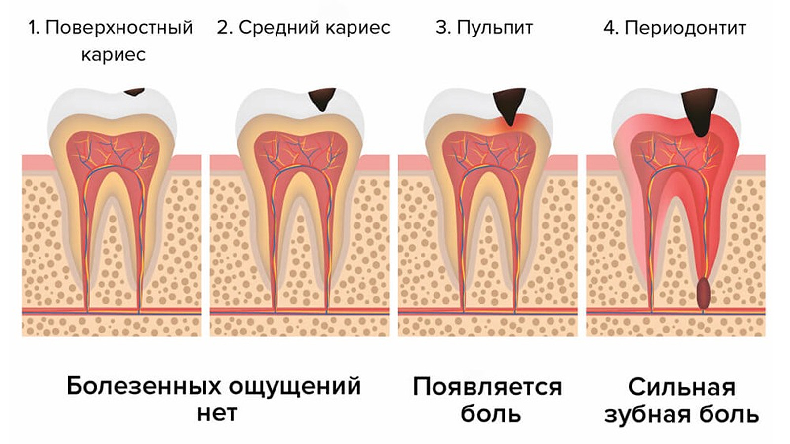 Инфографика: Четыре стадии кариеса зубов и связанные с ним заболевания
