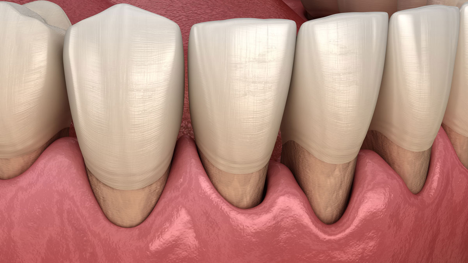 imaginea dinților cu gâturi expuse și gingii deformate în urma parodontozei