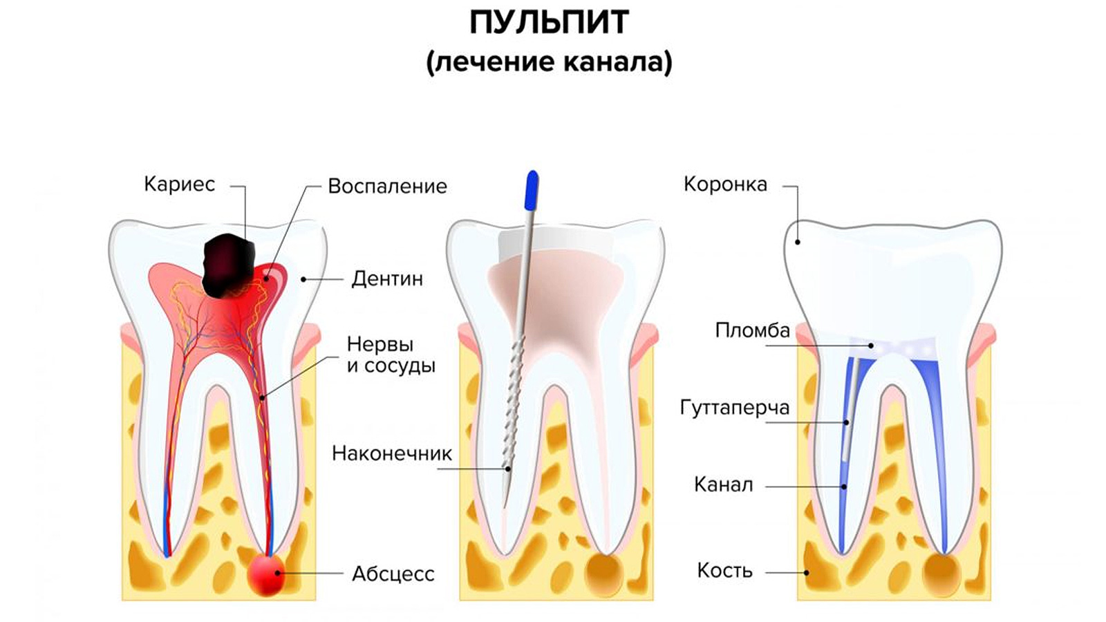 Пульпит и лечение корневого канала