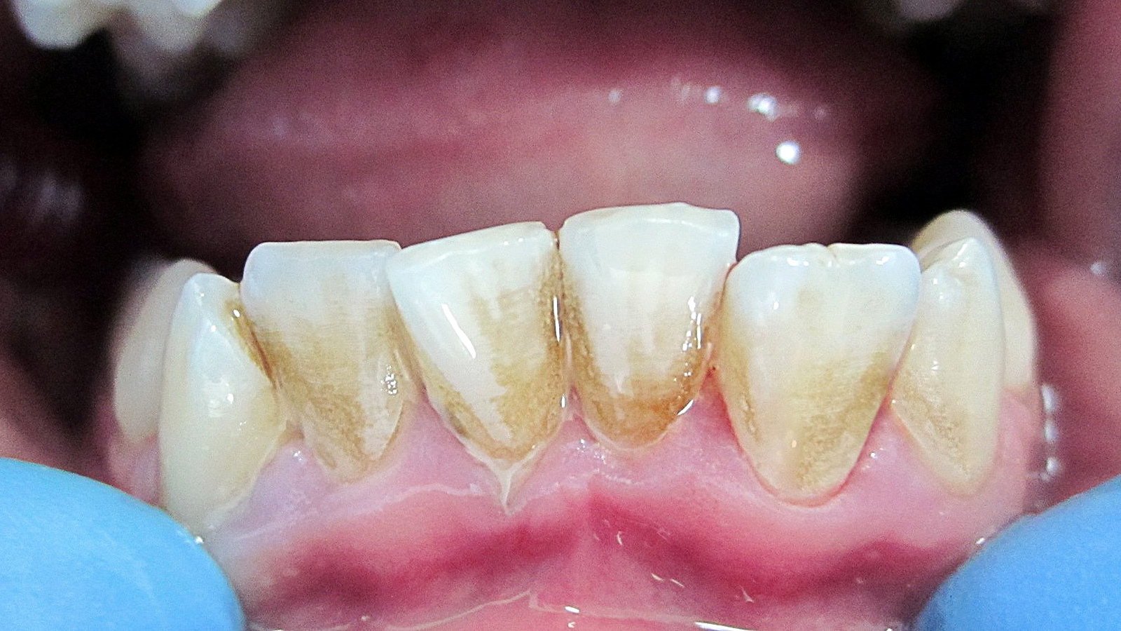 передние нижние зубы с зубным налетом