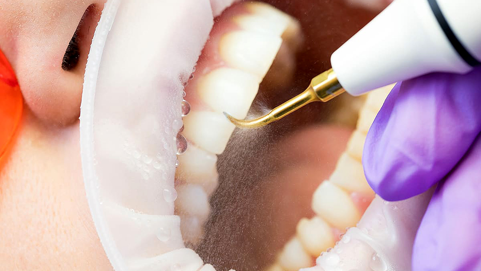 Ultrasonic dental plaque removal